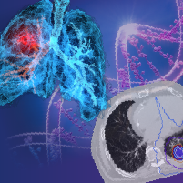 Tumor Board: Integrating Immunotherapy With Definitive and Perioperative Radiation Strategies in Stage I-III NSCLC