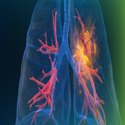 PER Global Perspectives: Differentiating and Managing Toxicities with TROP2-Targeted ADCs in NSCLC Through Multidisciplinary Pathways