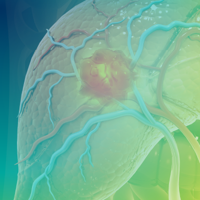 Medical Crossfire®: Closing Clinical Practice Gaps in Hepatobiliary Cancer With Emerging Immunotherapies and Delivery Innovations