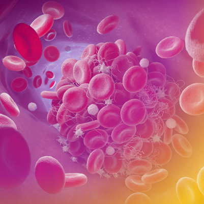 Cases and Conversations™: Endothelial Injury, Complement, and TA-TMA After Allogeneic Stem Cell Transplant