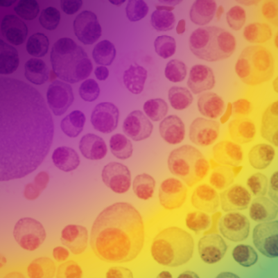 Medical Crossfire®: Translating Evolving Standards of Care in Newly Diagnosed Multiple Myeloma Into Individualized Treatment Strategies