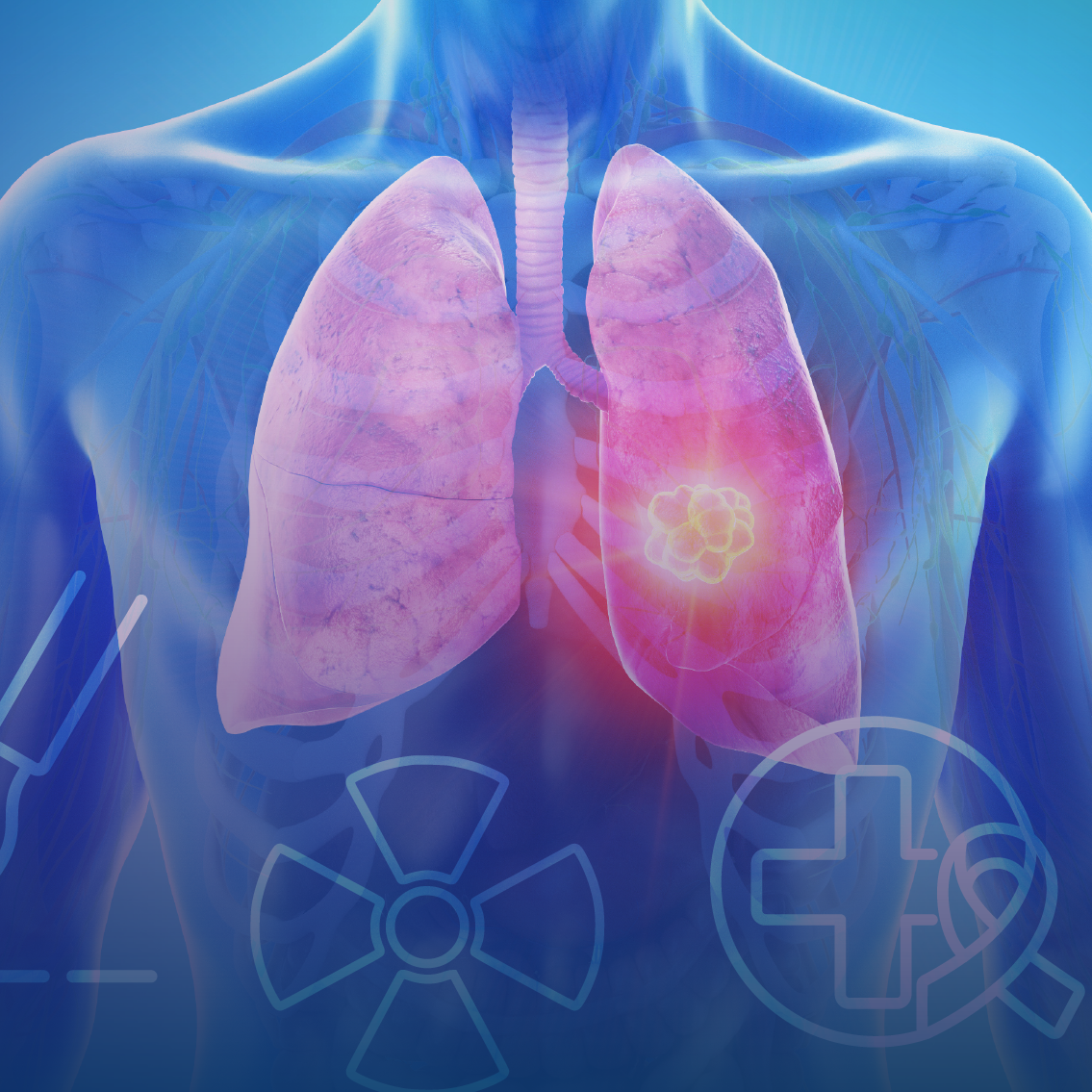 Tumor Board: Evolving Immunotherapy Strategies for Stage I–III NSCLC