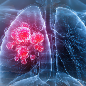 Live Tumor Board – From Trial to Practice: Integrating Current and Emerging Evidence into the Treatment of EGFR-Mutated NSCLC