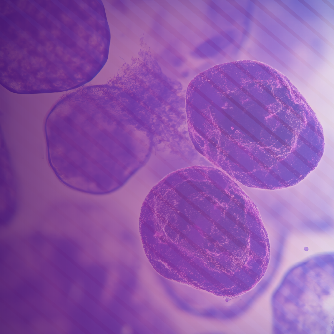 Navigating the Evolving Landscape of Acute Lymphoblastic Leukemia