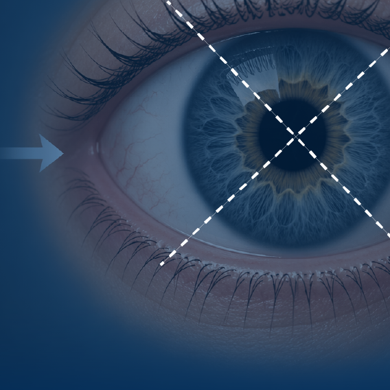 Searching for Silence: Corneal Sensitivity Testing in NK