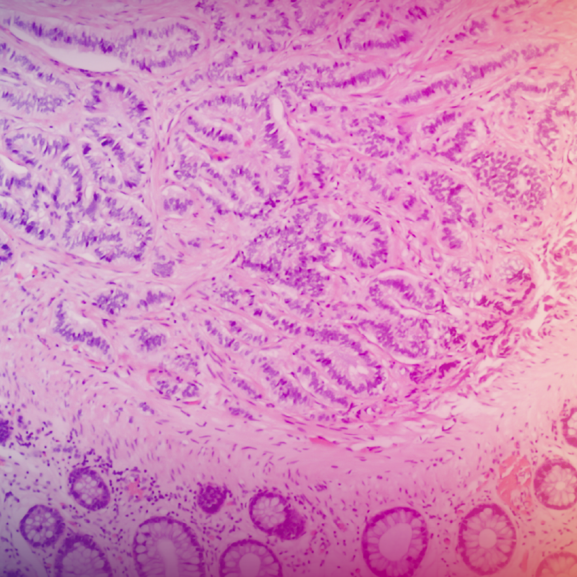 Cases and Conversations: Redefining EPNEC Diagnosis and Management—Integrating DLL3 Into Pathology Practice