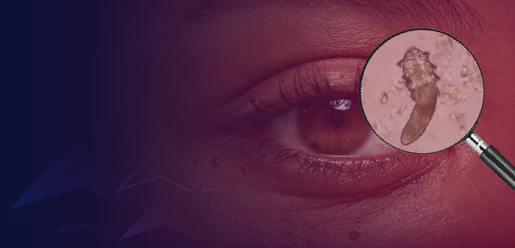 (CME Track) Beyond the Collarette: Empowering Patients in the Management of Demodex Blepharitis