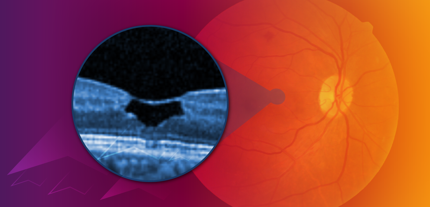 MacTel Decoded: Rethinking Conventional Approaches With Novel Neuroprotective Strategies