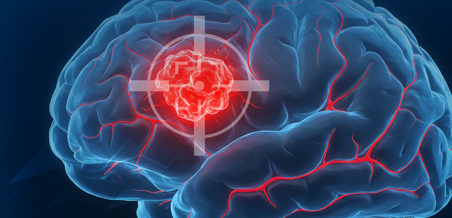 Tumor Board: Clinical Integration of Molecular Profiling in Glioma—Transforming the Use of Targeted Therapy