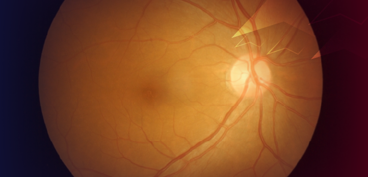 (CME Track) A Forward Look at Anti-VEGF Therapies: A Paradigm Shift in Neovascular Retinal Disease Management