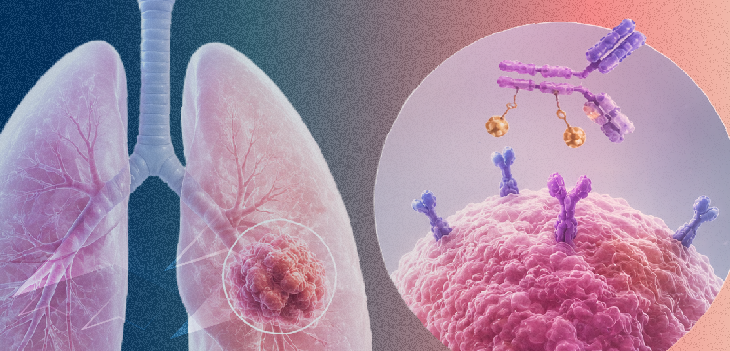 𝘔𝘌𝘛 Alterations in NSCLC: Applying Diagnostic Advances and Targeted Therapies in a New Era of Treatment