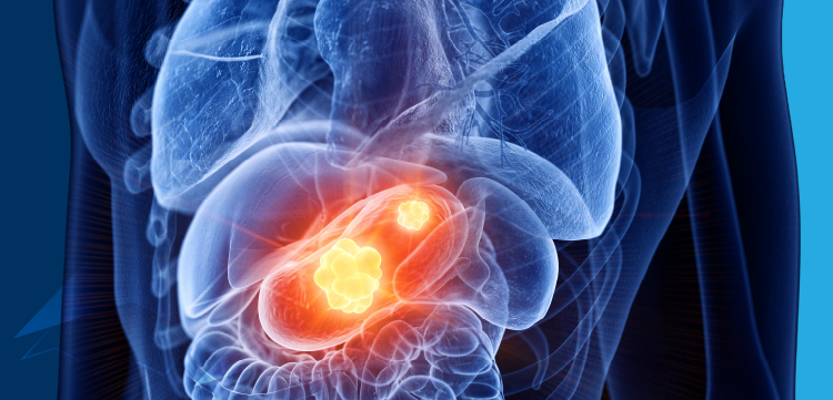 From Data to Decisions: Applying the Latest Evidence for New Targeted Therapies in HER2-Positive Gastroesophageal Adenocarcinoma