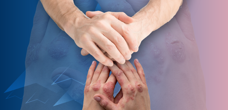 Publication Review: Defining On-Treatment Remission in Plaque Psoriasis