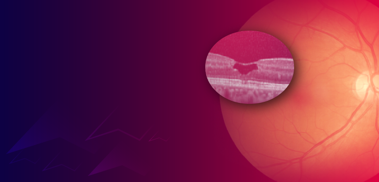 (CME Track) The Evolution of MacTel Management: Integrating Neuroprotective Therapies Into Clinical Practice