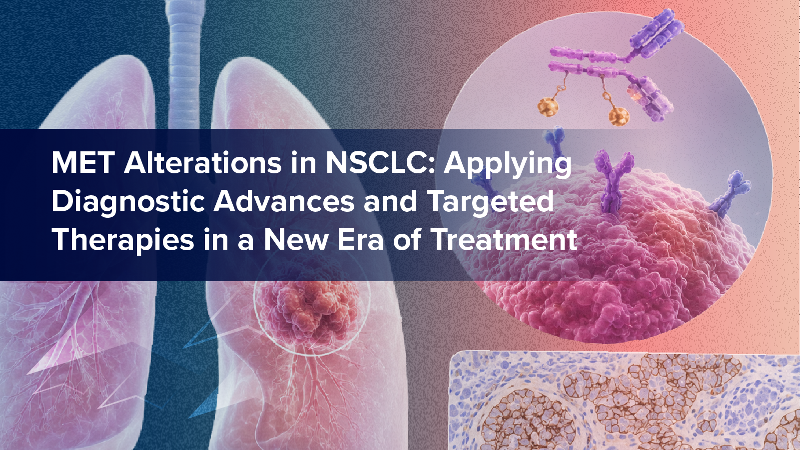 𝘔𝘌𝘛 Alterations in NSCLC: Applying Diagnostic Advances and Targeted Therapies in a New Era of Treatment
