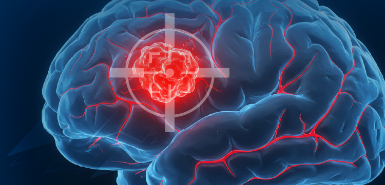 Tumor Board: Clinical Integration of Molecular Profiling in Glioma - Transforming the Use of Targeted Therapy