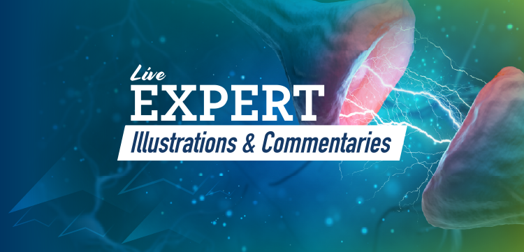(CME Track) Live Expert Illustrations & Commentary™: Visualizing Novel Therapeutic Targets for Patients with Major Depressive Disorder