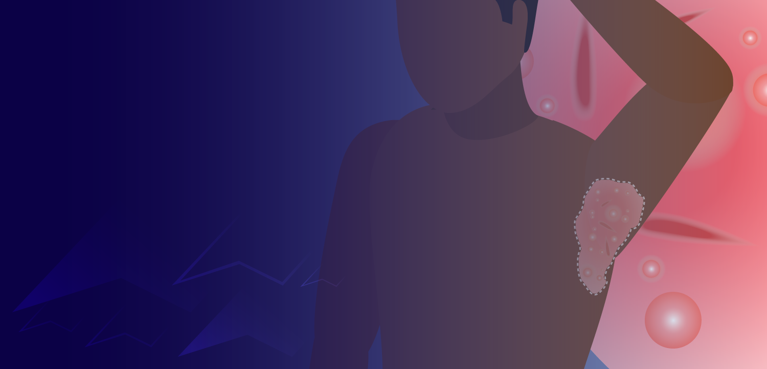 Hidradenitis Suppurativa: Diving Deeper Into Disease Pathogenesis, Severity Assessment, and Holistic Management Approaches