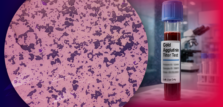 Cases & Conversations: Real-World Insights on the Diagnosis and Management of Cold Agglutinin Disease