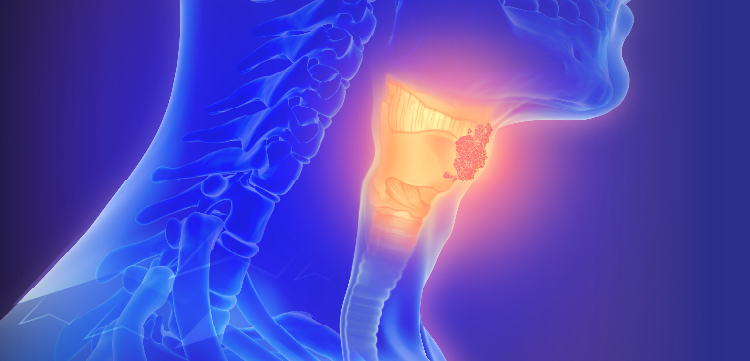 Live Tumor Board: Squamous Cell Carcinoma of the Head & Neck – Post-CRT Decisions in the Locally Advanced Setting