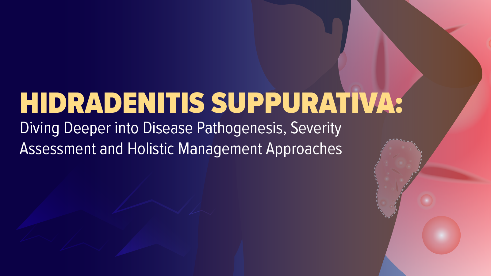Hidradenitis Suppurativa: Diving Deeper Into Disease Pathogenesis, Severity Assessment, and Holistic Management Approaches