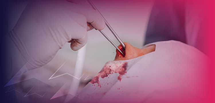The ENT Surgeon's Edge: The Case for Effective Anesthesia with Vasoconstriction