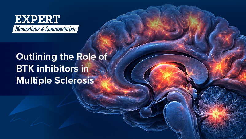 Expert Illustrations & Commentaries™: Outlining the Role of BTK inhibitors in Multiple Sclerosis