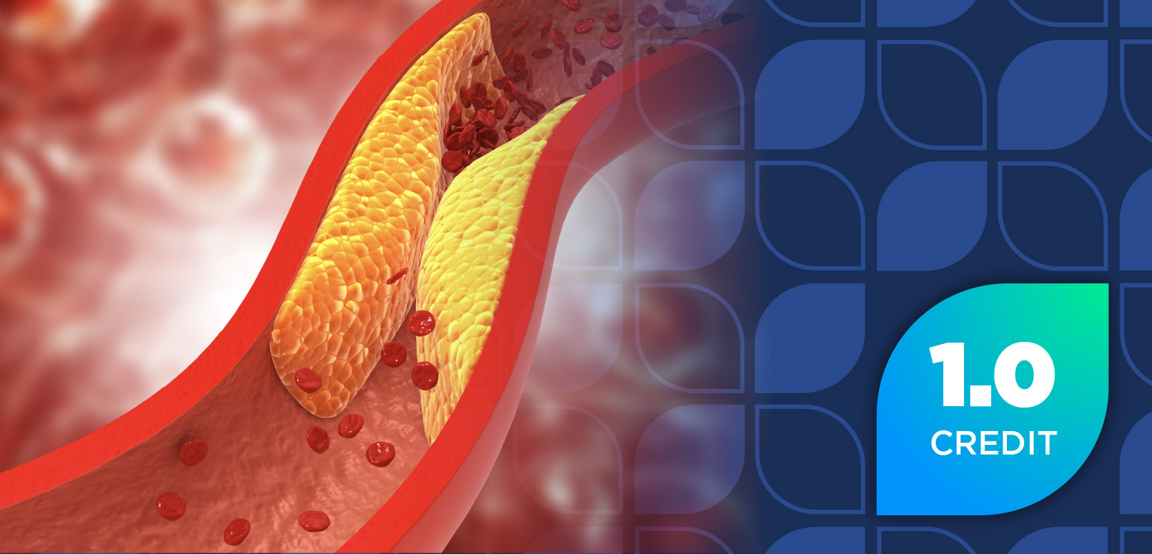 Improving Outcomes in Lipid Management: Aligning Managed Care Policy With Emerging Guideline Updates and Non-Statin Therapeutic Advances