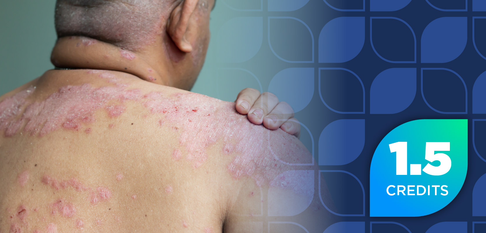 The Expanding Psoriasis Treatment Landscape: Leveraging the Pharmacist's Role in Patient Care to Improve Access and Outcomes for TYK Inhibitors