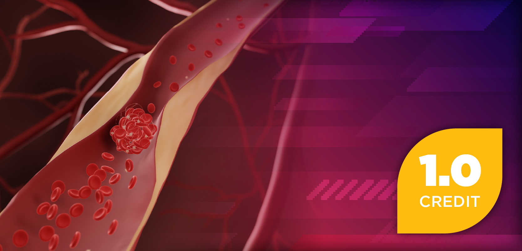 Emerging Factor XIa Inhibitor Therapy: Implications for Pharmacist-Led Stroke Prevention