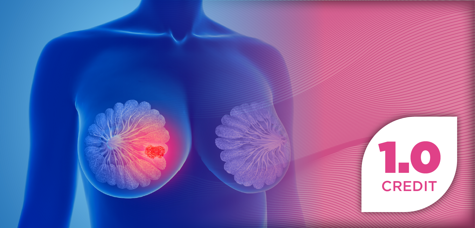 Optimizing Therapy in HR+/HER2-Negative Metastatic Breast Cancer: Navigating Novel Treatments and Personalized Care