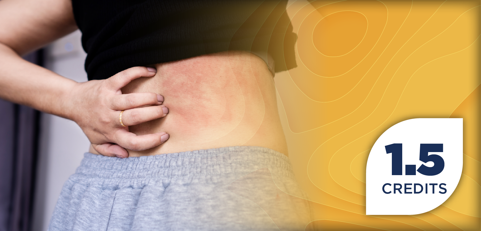 From Flares to Freedom: Navigating the Journey of Patients With Chronic Spontaneous Urticaria With Next-Generation Therapies