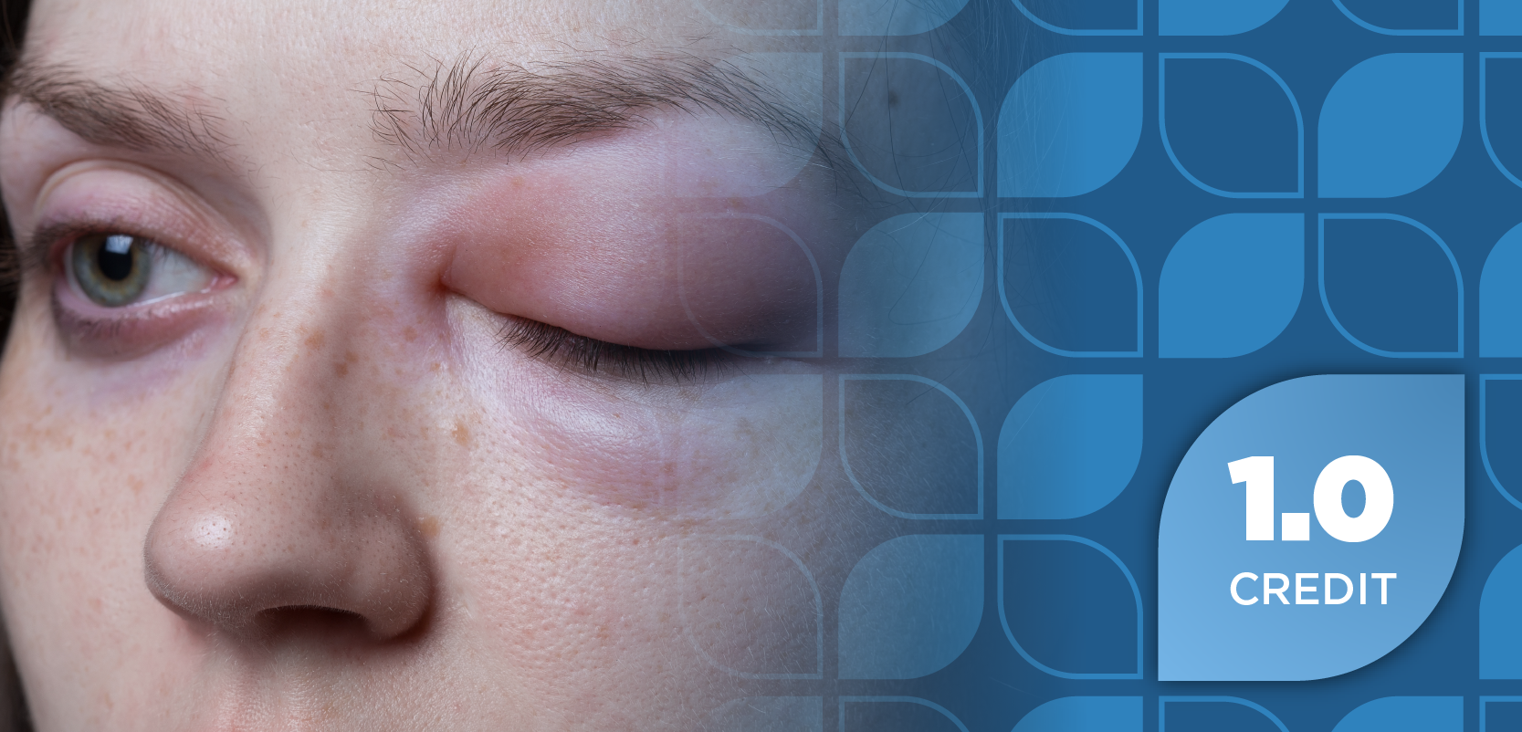 From Treatment to Prevention: Navigating the Expanding Hereditary Angioedema Treatment Landscape