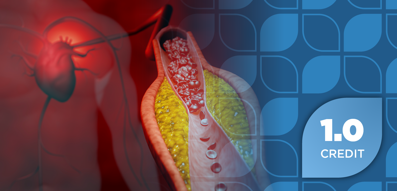 Optimizing Lipid Management in Statin-Intolerant Populations: Payer Strategies for Evidence-Based Access and Risk Reduction