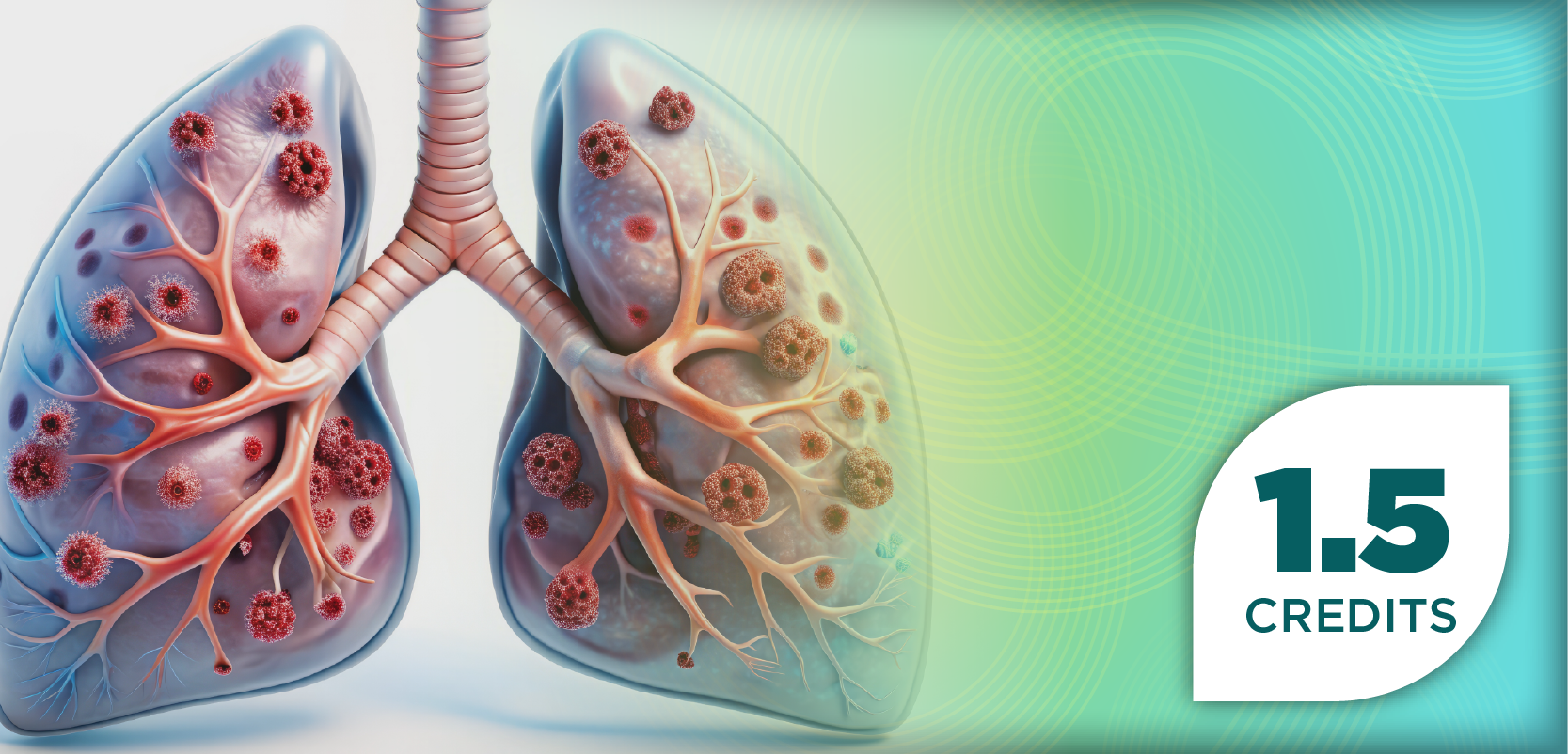 Advancing the Idiopathic Pulmonary Fibrosis Treatment Landscape: What’s Next in Care