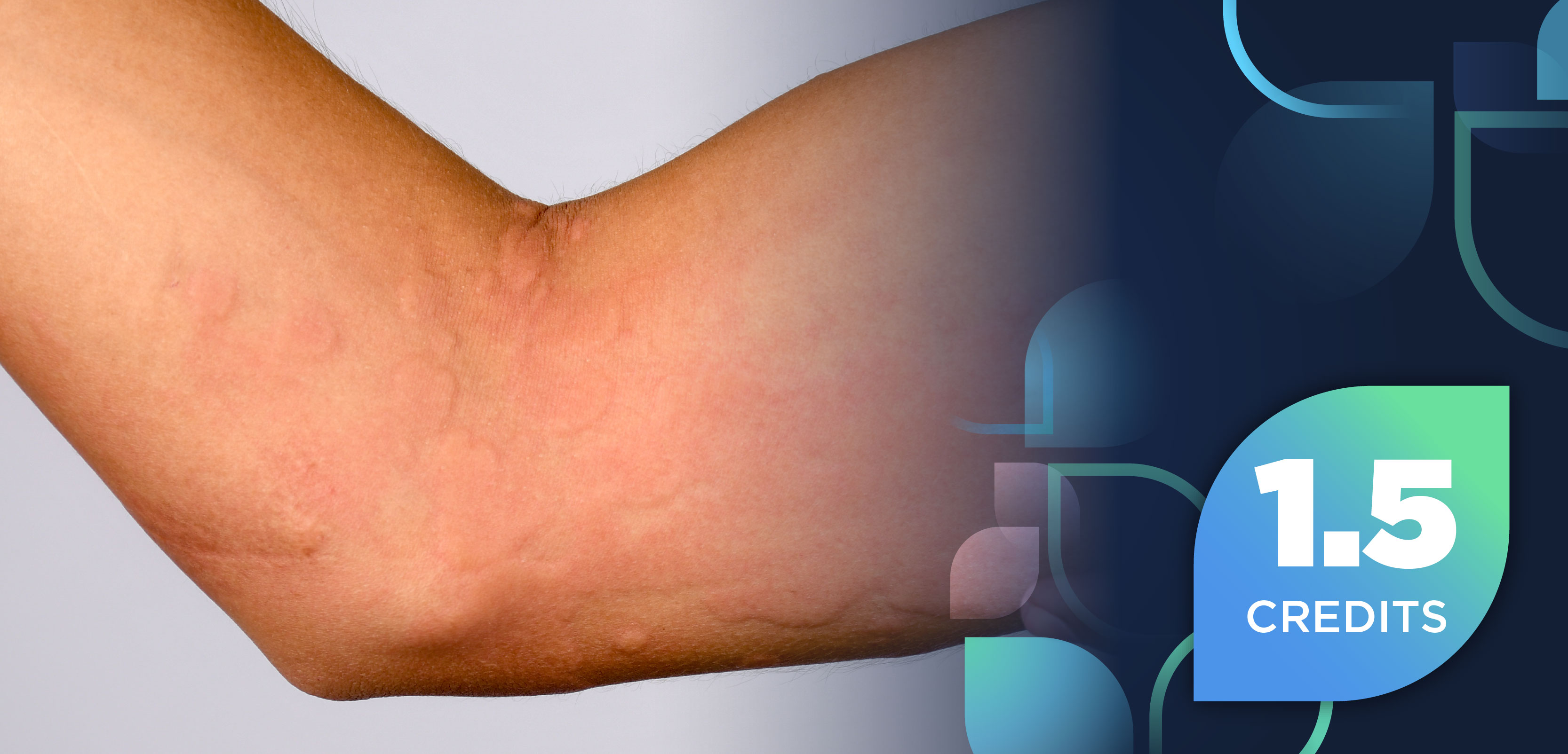 Advancing Care in Chronic Spontaneous Urticaria: Integrating Emerging Therapies and Specialty Pharmacy Best Practices