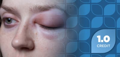 From Treatment to Prevention: Navigating the Expanding Hereditary Angioedema Treatment Landscape