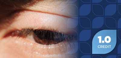 An Eye on Access: Managed Care Perspectives in Demodex Blepharitis