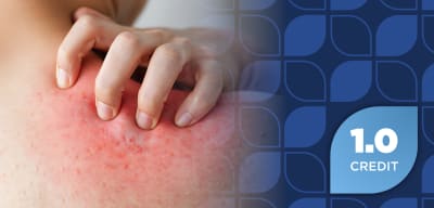 Optimizing Access and Outcomes in Chronic Spontaneous Urticaria: Evaluating the Therapeutic Landscape Through a Managed Care Lens