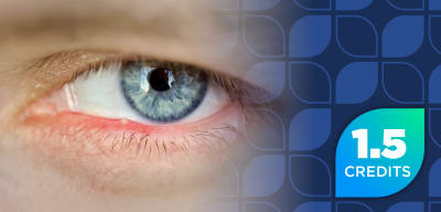 Evolving Care: Treating Demodex Blepharitis for Pharmacists (Pharmacist Credit)