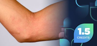 Advancing Care in Chronic Spontaneous Urticaria: Integrating Emerging Therapies and Specialty Pharmacy Best Practices