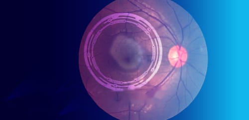 Une Vision d’Espoir: Lighting the Way in GA Management & Treatment