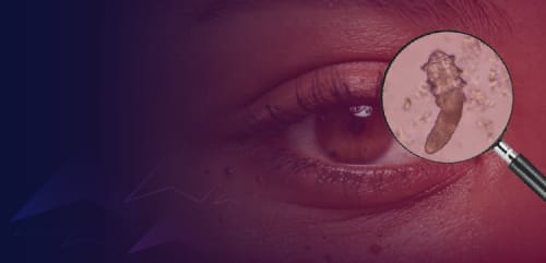 Beyond the Collarette: Empowering Patients in the Management of Demodex Blepharitis
