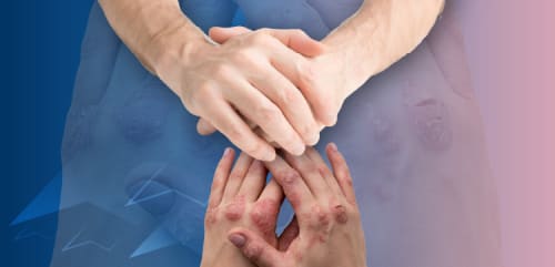 Publication Review: Defining On-Treatment Remission in Plaque Psoriasis