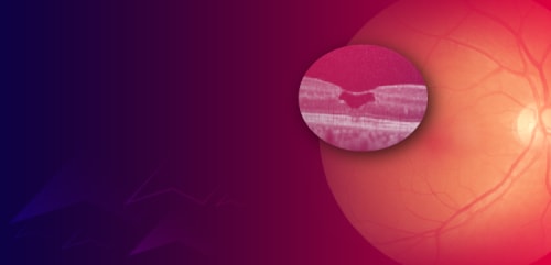 The Evolution of MacTel Management: Integrating Neuroprotective Therapies Into Clinical Practice